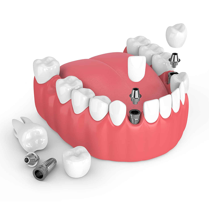 Dental Implant